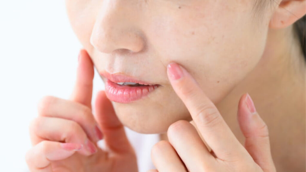 肌荒れは腸内環境が原因？便秘との関係を解説
